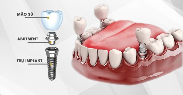 Cấy ghép Implant