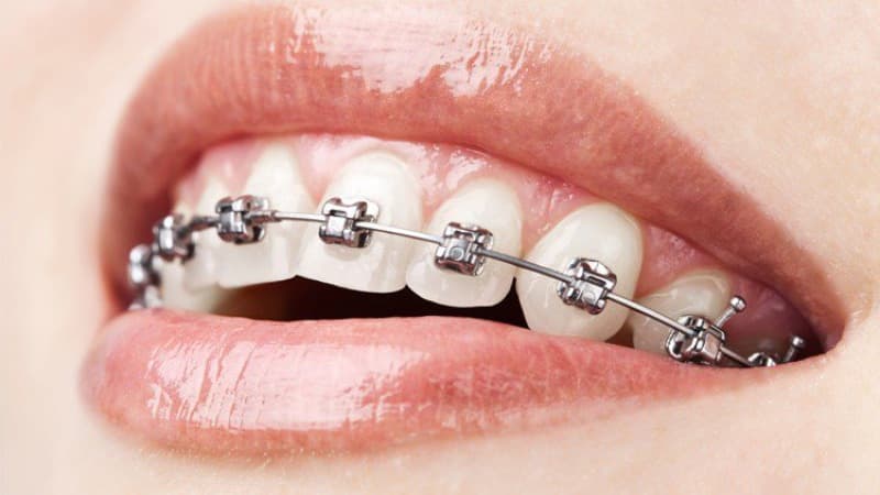 Niềng Răng Truyền Thống
