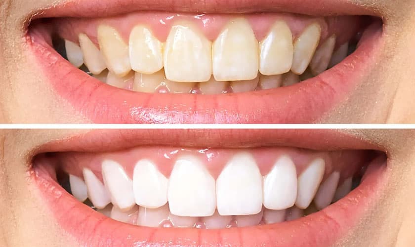 Răng sứ thẩm mỹ