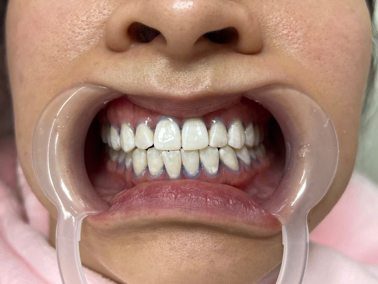 PHẠM LƯU VI - Sau điều trị