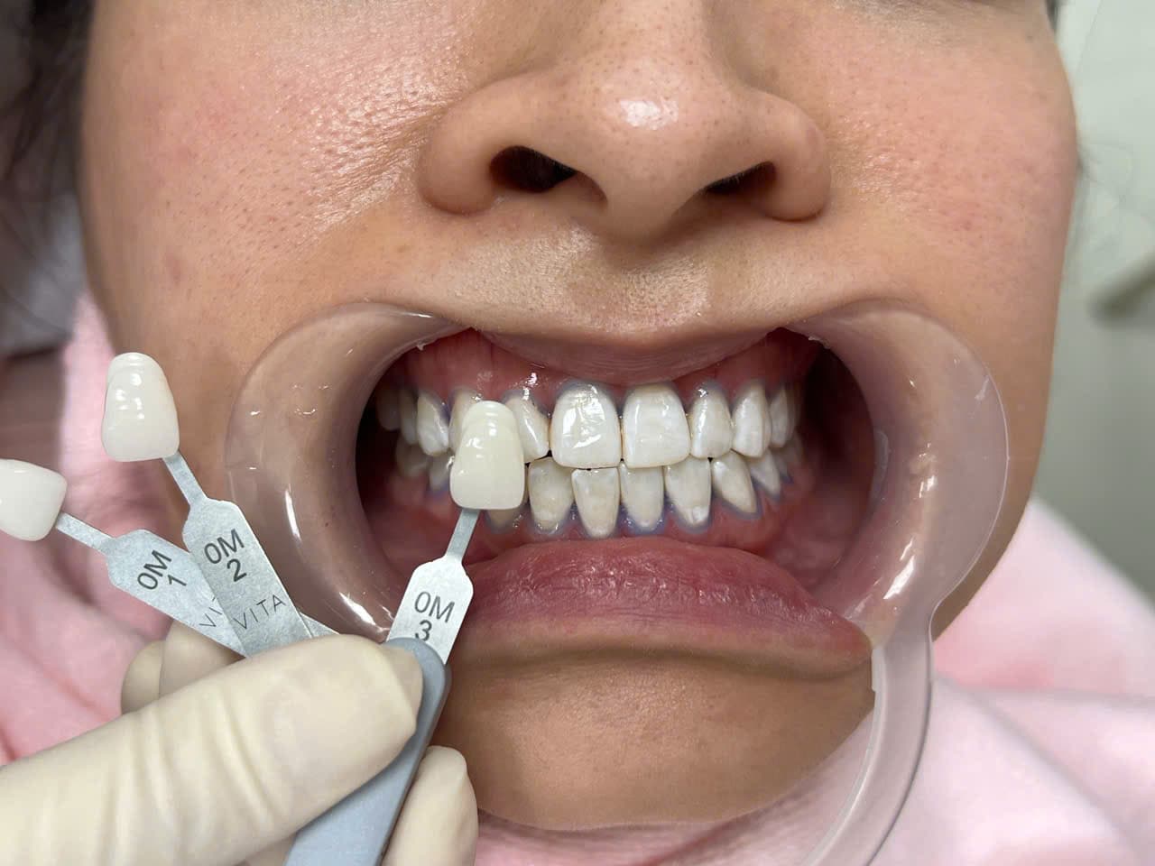 PHẠM LƯU VI - Sau điều trị chi tiết