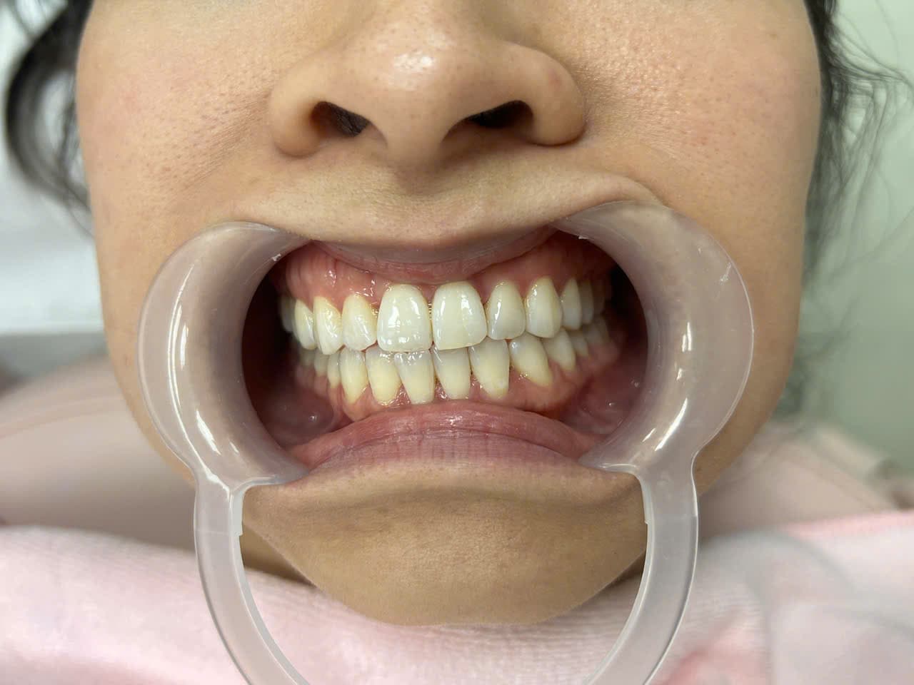 PHẠM LƯU VI - Trước điều trị