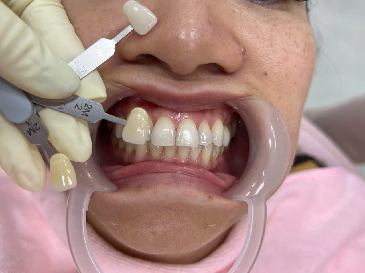 TRẦN NHƯ KIM VŨ - Trước điều trị chi tiết