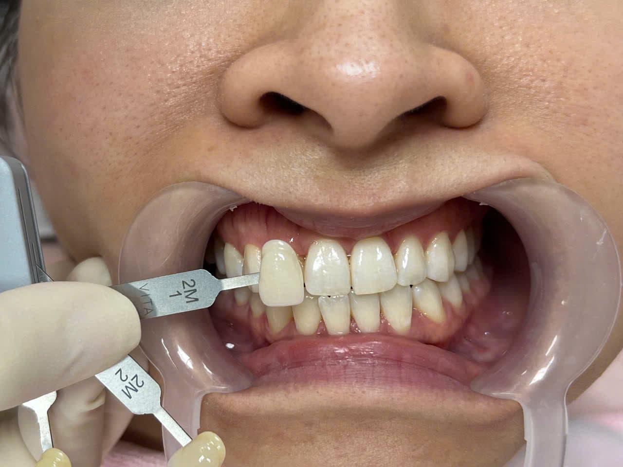 PHẠM LƯU VI - Trước điều trị chi tiết
